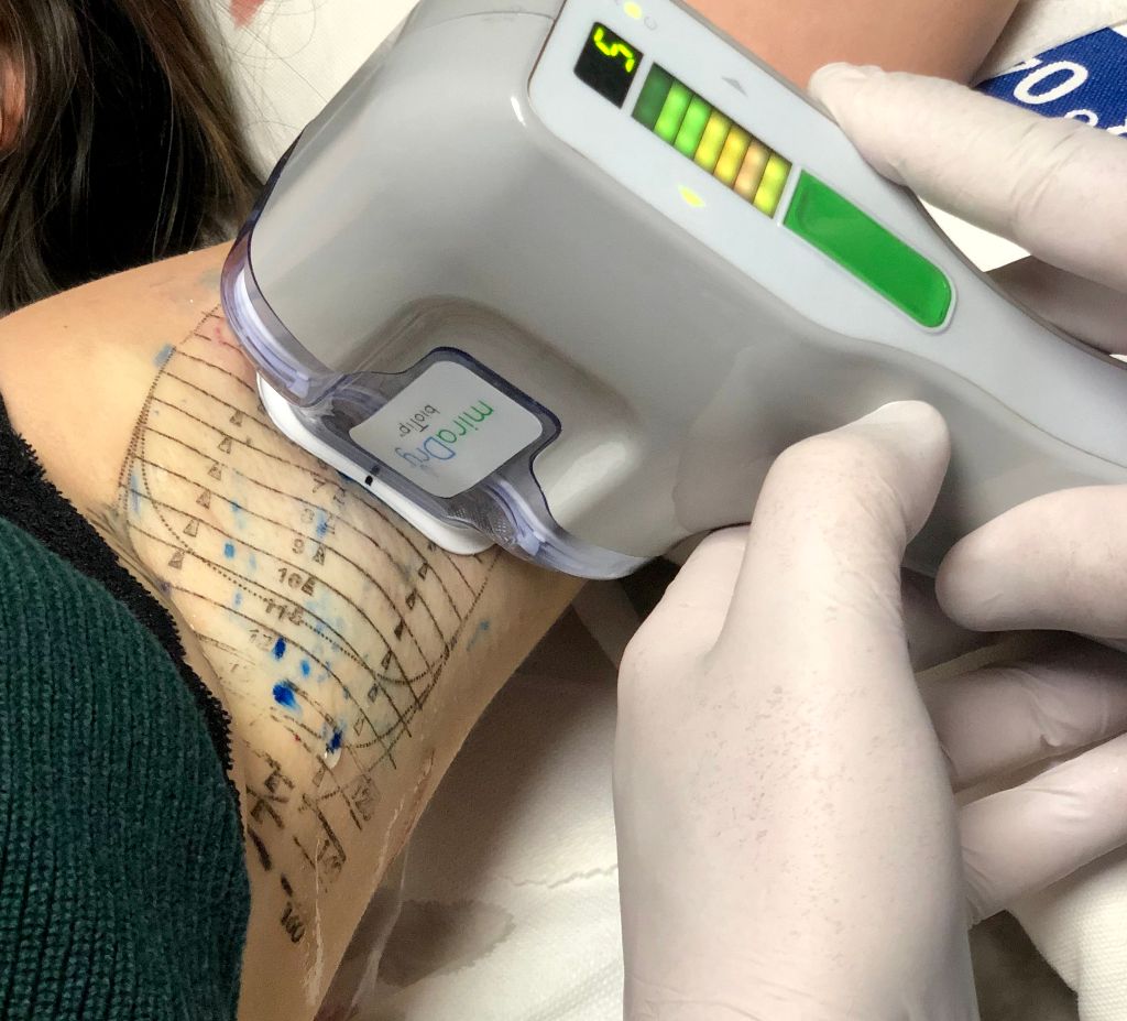 Miradry transpiration aisselles Lyon Chirurgie dermatologique Magis