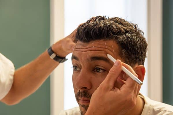 Injection de Botox pour la ride du lion réalisée au cabinet du Dr Quentin Magis à Lyon 2ᵉ