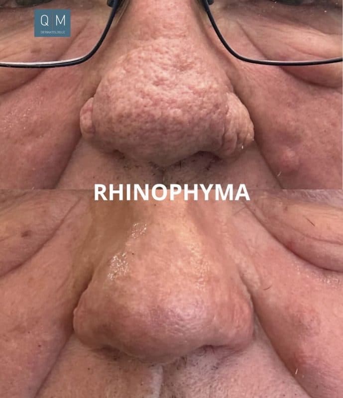 Traitement du rhinophyma au laser CO2 ultra pulsé à Lyon par le Dr Quentin Magis